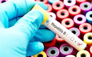 Hepatit B